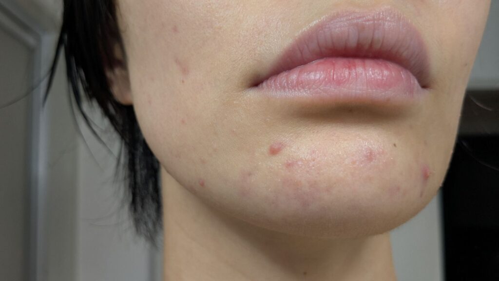 【ゆる企画】食生活見直せや祭1日目の吹き出物の様子