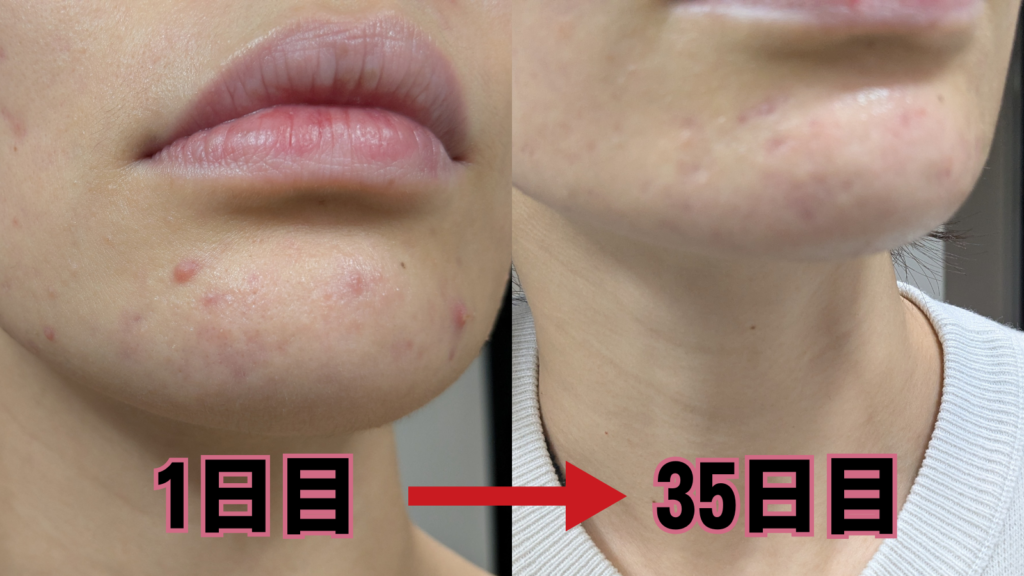 食生活を見直して1ヶ月。吹き出物は…
