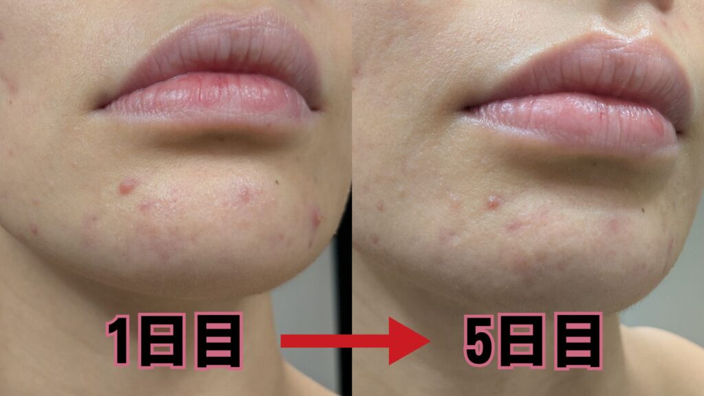 【食生活見直せや祭 途中経過】1日目と5日目の吹き出物の様子を比較